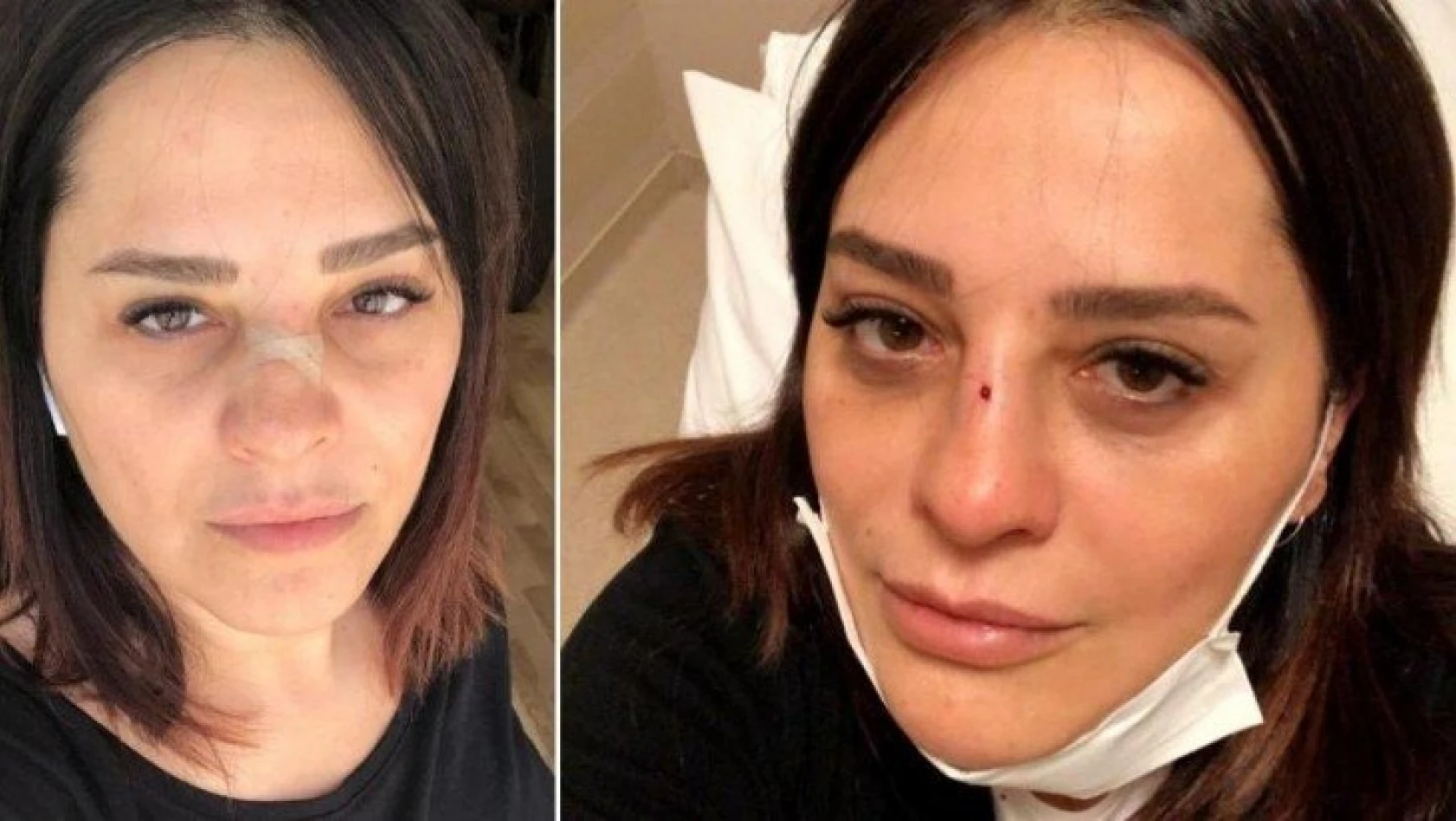 Ünlü şarkıcı Reyhan Karaca'nın burnu kırıldı!